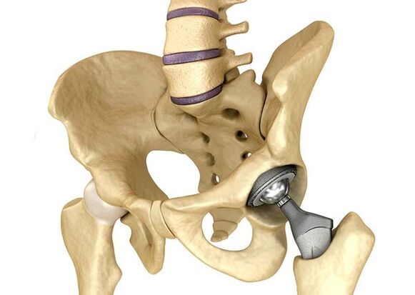Hip joint endoprostetics