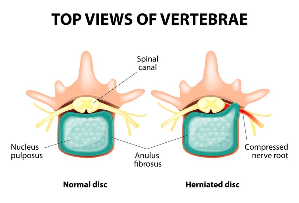 Healthy intervertebral disk and hernia