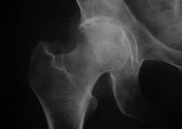 X-ray of the hip joint with arthrosis