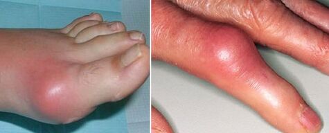 the appearance of arthritic joints