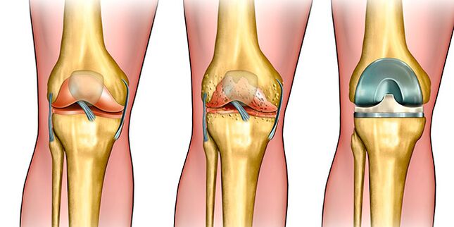 In the third stage of arthrosis, knee replacement is required