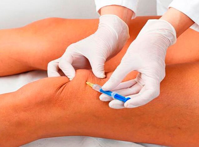 Intra-articular injections of drugs for arthrosis of the knee joint