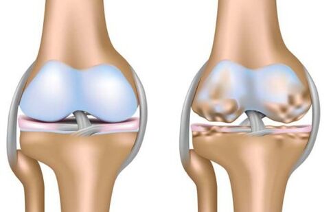 healthy articulation and destruction of the knee joint in osteoarthritis