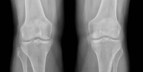 x-ray knee osteoarthritis