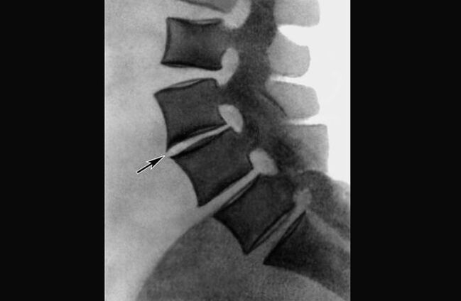 Radiographic manifestations of osteochondrosis of the thoracic spine