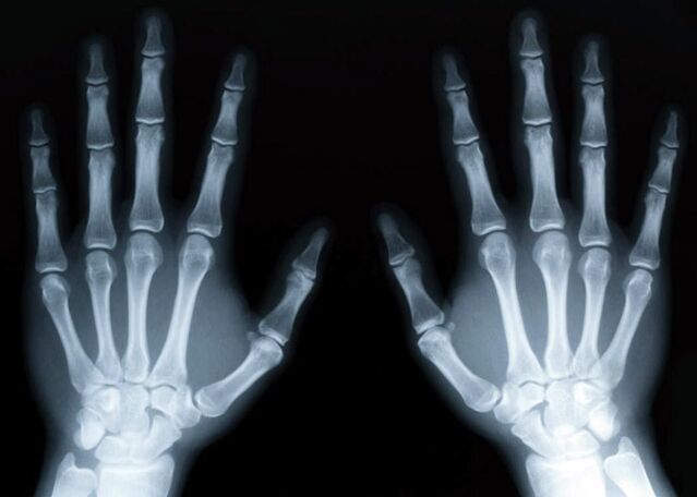 Gout provokes the development of gouty arthritis, which can be diagnosed using x-rays