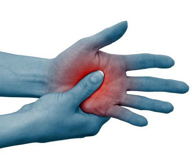 Severe pain in the joints of the fingers, which decreases with physical exercise, is a typical sign of rheumatoid arthritis. 